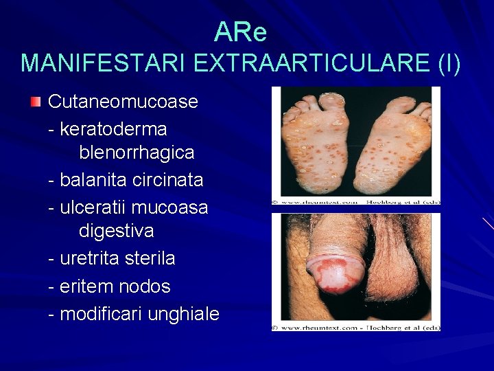 ARe MANIFESTARI EXTRAARTICULARE (I) Cutaneomucoase - keratoderma blenorrhagica - balanita circinata - ulceratii mucoasa ARe MANIFESTARI EXTRAARTICULARE (I) Cutaneomucoase - keratoderma blenorrhagica - balanita circinata - ulceratii mucoasa