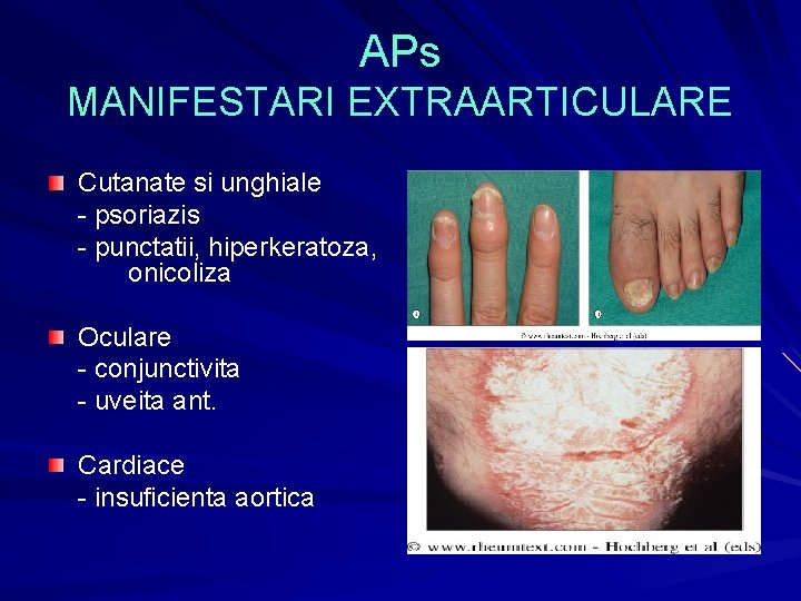APs MANIFESTARI EXTRAARTICULARE Cutanate si unghiale - psoriazis - punctatii, hiperkeratoza, onicoliza Oculare - APs MANIFESTARI EXTRAARTICULARE Cutanate si unghiale - psoriazis - punctatii, hiperkeratoza, onicoliza Oculare -