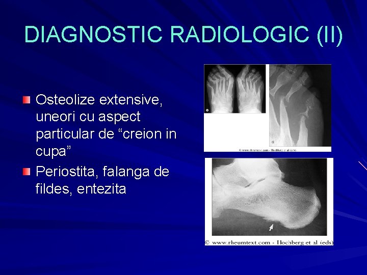 DIAGNOSTIC RADIOLOGIC (II) Osteolize extensive, uneori cu aspect particular de “creion in cupa” Periostita, DIAGNOSTIC RADIOLOGIC (II) Osteolize extensive, uneori cu aspect particular de “creion in cupa” Periostita,