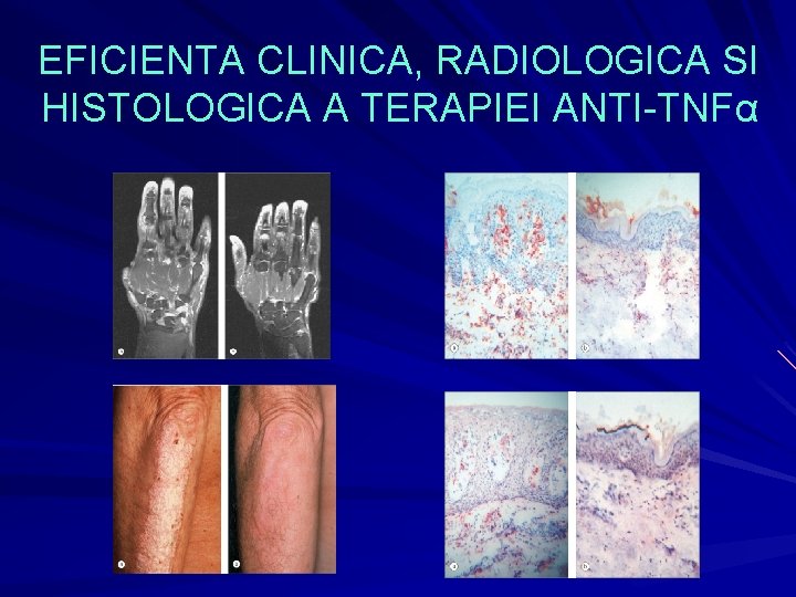 EFICIENTA CLINICA, RADIOLOGICA SI HISTOLOGICA A TERAPIEI ANTI-TNFα EFICIENTA CLINICA, RADIOLOGICA SI HISTOLOGICA A TERAPIEI ANTI-TNFα