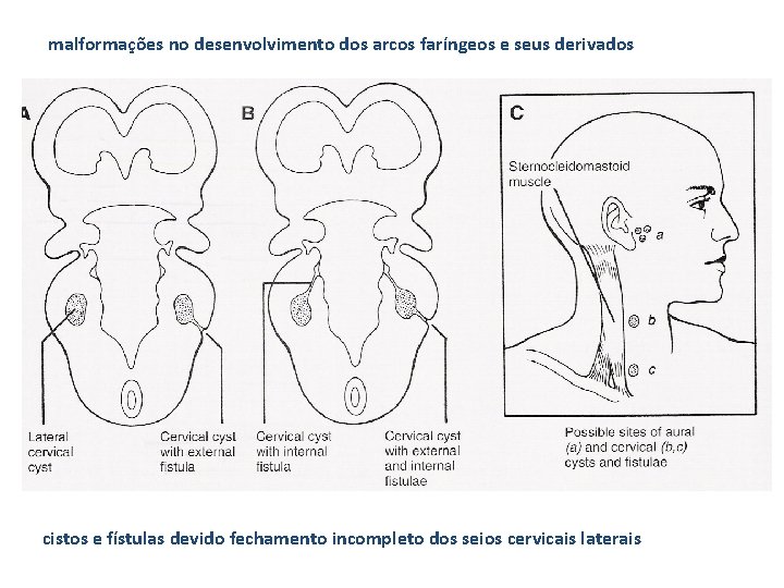 malformações no desenvolvimento dos arcos faríngeos e seus derivados cistos e fístulas devido fechamento