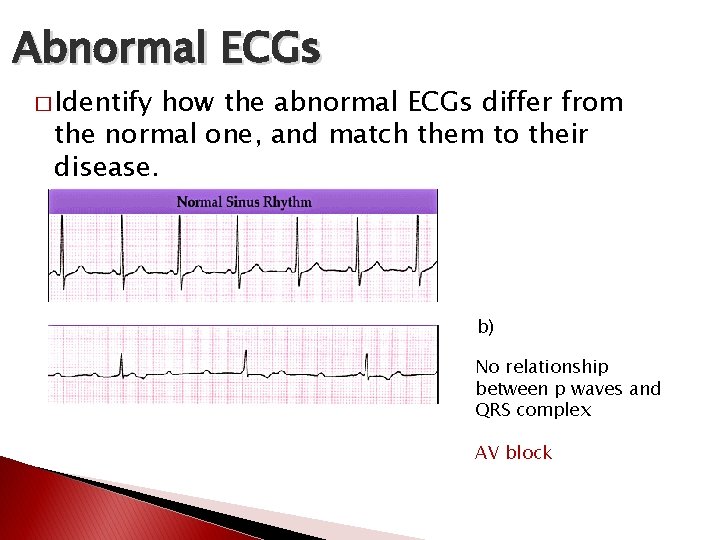 Abnormal ECGs � Identify how the abnormal ECGs differ from the normal one, and