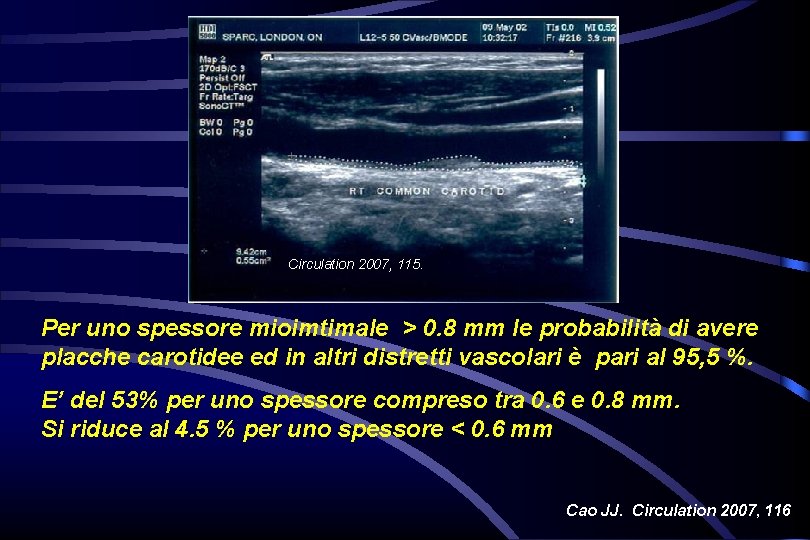 Circulation 2007, 115. Per uno spessore mioimtimale > 0. 8 mm le probabilità di Circulation 2007, 115. Per uno spessore mioimtimale > 0. 8 mm le probabilità di