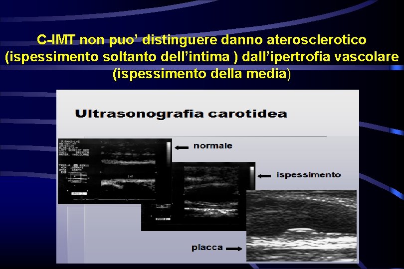 C-IMT non puo’ distinguere danno aterosclerotico (ispessimento soltanto dell’intima ) dall’ipertrofia vascolare (ispessimento della C-IMT non puo’ distinguere danno aterosclerotico (ispessimento soltanto dell’intima ) dall’ipertrofia vascolare (ispessimento della
