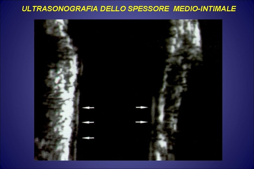 ULTRASONOGRAFIA DELLO SPESSORE MEDIO-INTIMALE ULTRASONOGRAFIA DELLO SPESSORE MEDIO-INTIMALE