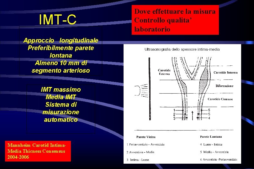 IMT-C Approccio longitudinale Preferibilmente parete lontana Almeno 10 mm di segmento arterioso IMT massimo IMT-C Approccio longitudinale Preferibilmente parete lontana Almeno 10 mm di segmento arterioso IMT massimo