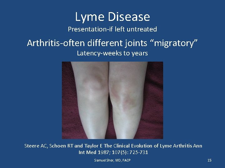 Lyme Disease Presentation-if left untreated Arthritis-often different joints “migratory” Latency-weeks to years Steere AC,