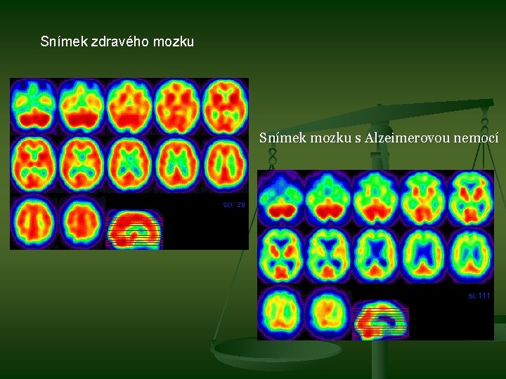 Snímek zdravého mozku Snímek mozku s Alzeimerovou nemocí 