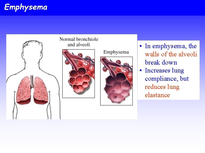 Emphysema • In emphysema, the walls of the alveoli break down • Increases lung