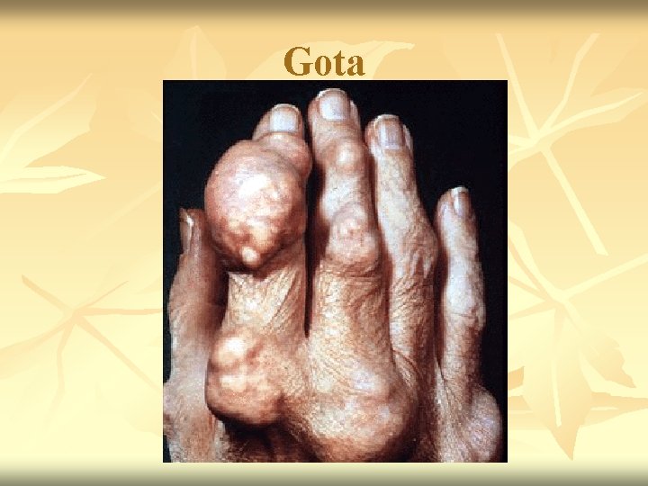 Gota 