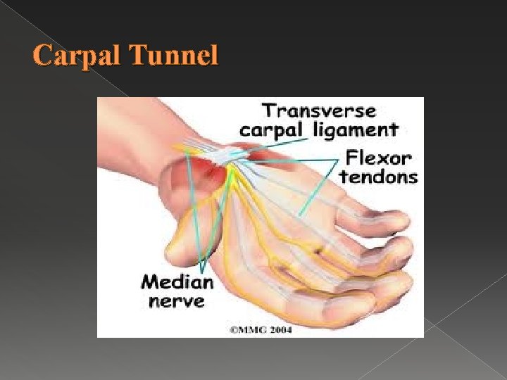 Carpal Tunnel 