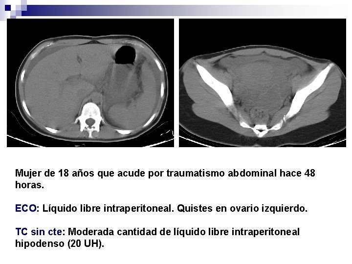 Mujer de 18 años que acude por traumatismo abdominal hace 48 horas. ECO: Líquido