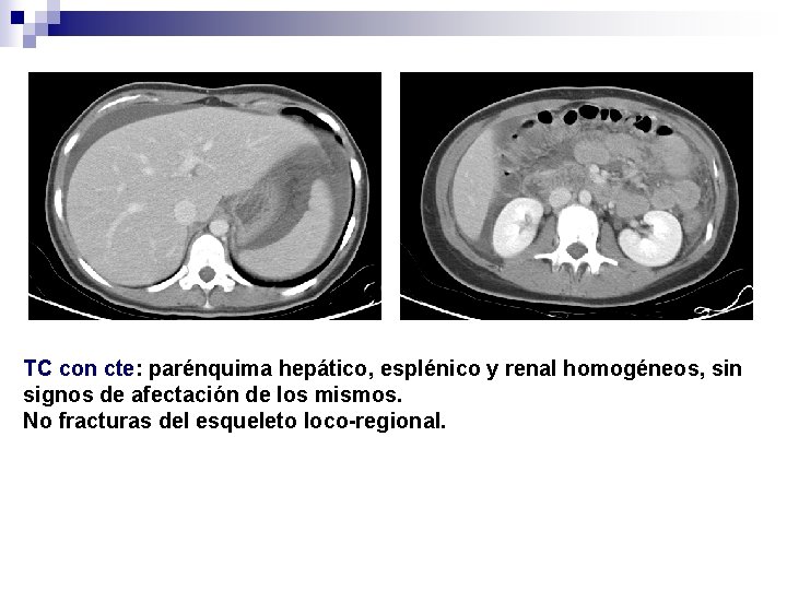 TC con cte: parénquima hepático, esplénico y renal homogéneos, sin signos de afectación de