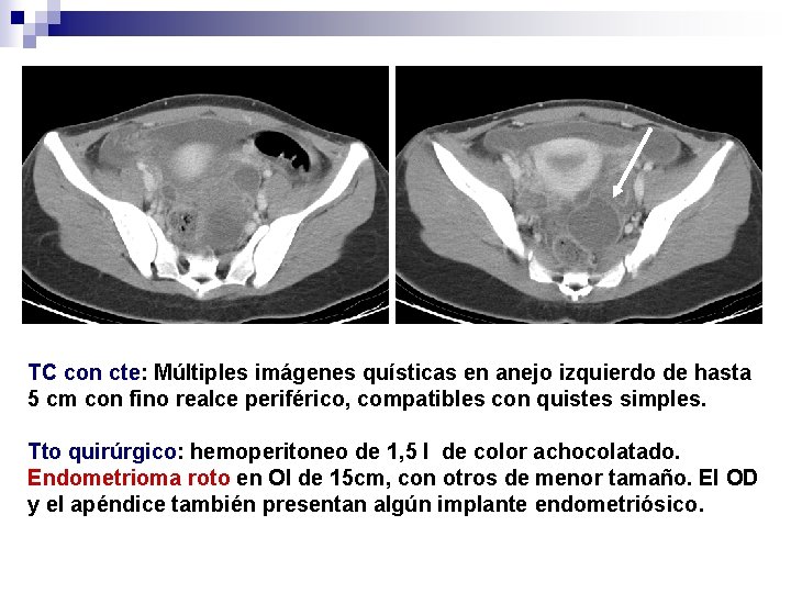 TC con cte: Múltiples imágenes quísticas en anejo izquierdo de hasta 5 cm con