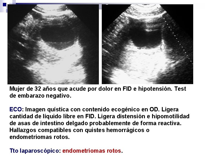 Mujer de 32 años que acude por dolor en FID e hipotensión. Test de