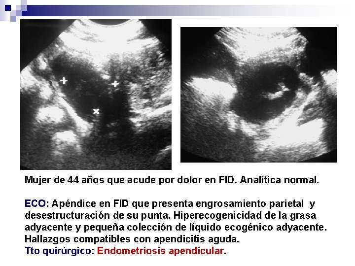 Mujer de 44 años que acude por dolor en FID. Analítica normal. ECO: Apéndice