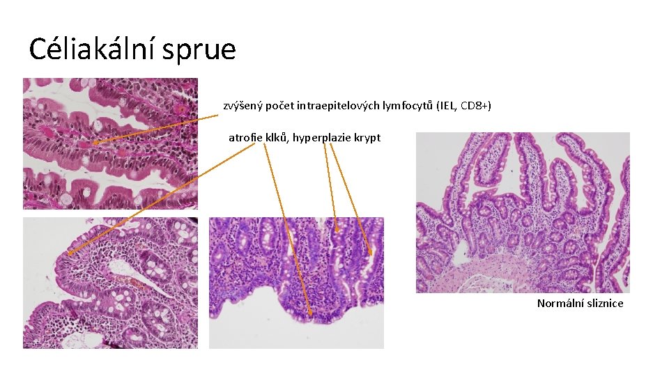 Céliakální sprue zvýšený počet intraepitelových lymfocytů (IEL, CD 8+) atrofie klků, hyperplazie krypt Normální