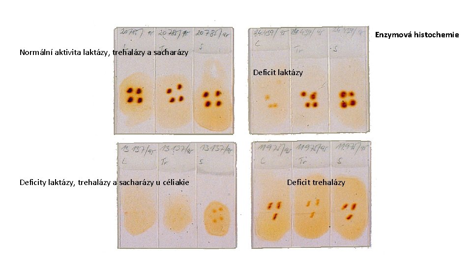 Enzymová histochemie Normální aktivita laktázy, trehalázy a sacharázy Deficit laktázy Deficity laktázy, trehalázy a