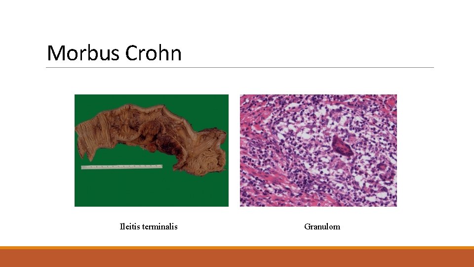 Morbus Crohn Ileitis terminalis Granulom 