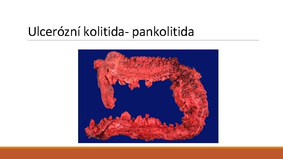 Ulcerózní kolitida- pankolitida 