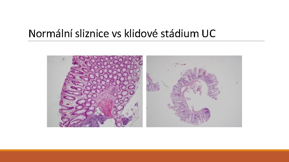 Normální sliznice vs klidové stádium UC 