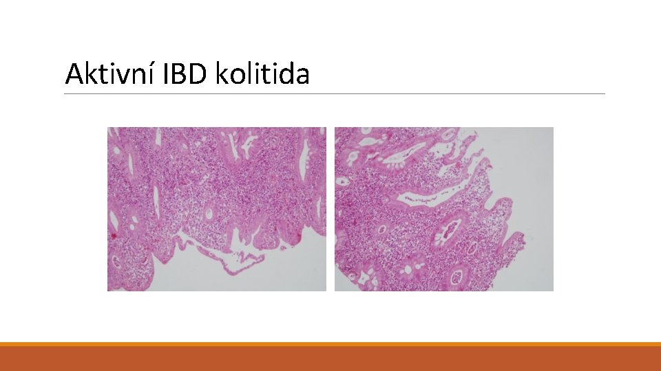 Aktivní IBD kolitida 