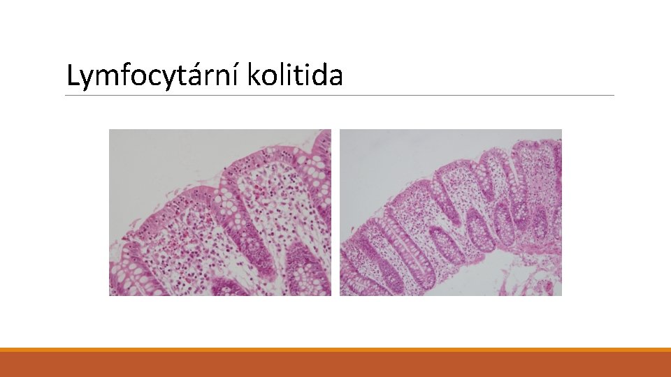 Lymfocytární kolitida 
