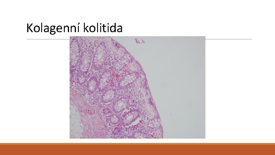 Kolagenní kolitida 