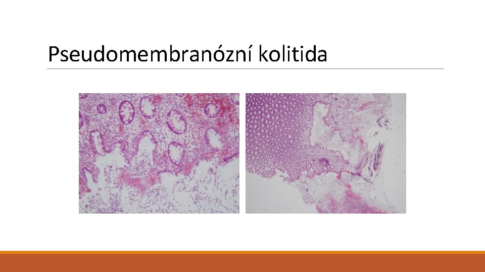 Pseudomembranózní kolitida 