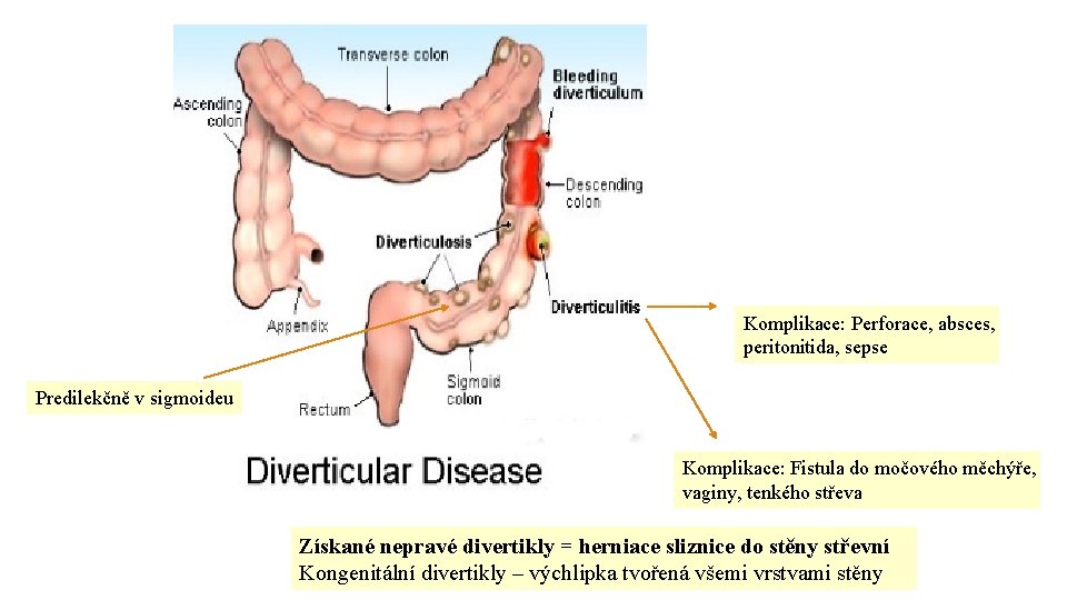 Komplikace: Perforace, absces, peritonitida, sepse Predilekčně v sigmoideu Komplikace: Fistula do močového měchýře, vaginy,