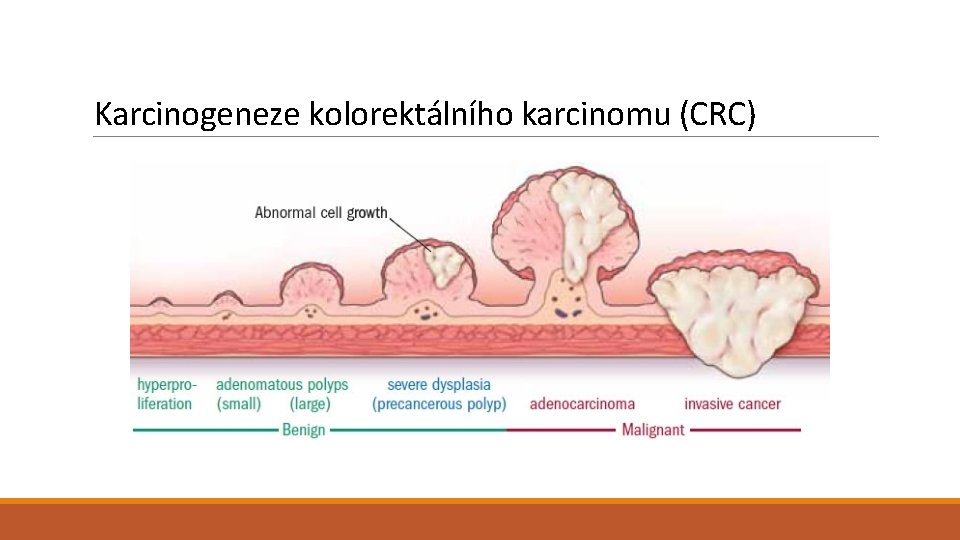 Karcinogeneze kolorektálního karcinomu (CRC) 