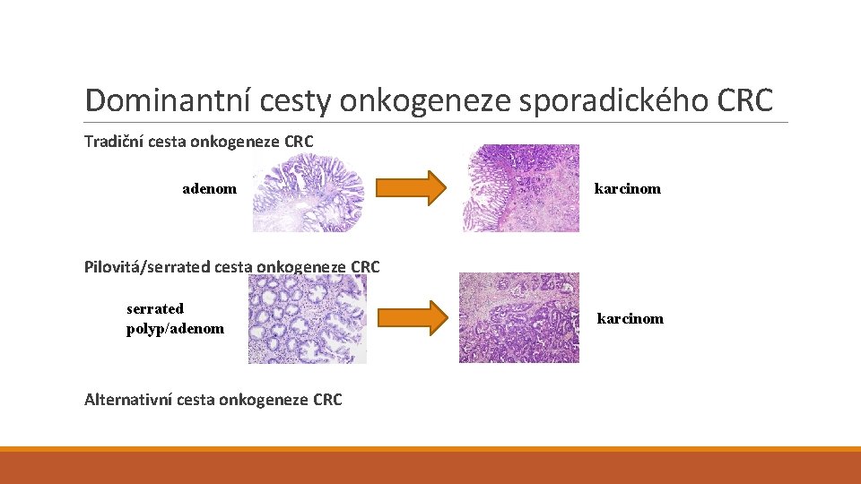 Dominantní cesty onkogeneze sporadického CRC Tradiční cesta onkogeneze CRC adenom karcinom Pilovitá/serrated cesta onkogeneze