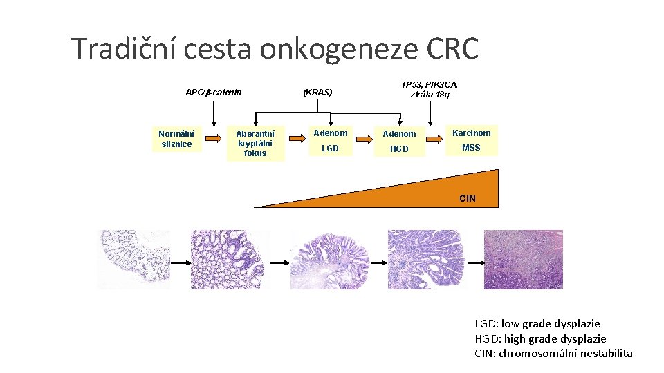 Tradiční cesta onkogeneze CRC APC/b-catenin Normální sliznice Aberantní kryptální fokus (KRAS) TP 53, PIK