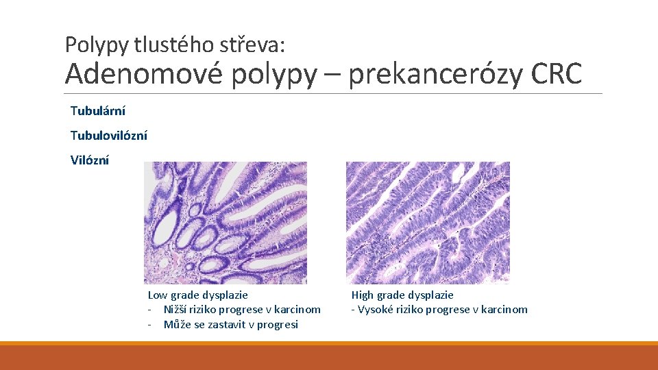 Polypy tlustého střeva: Adenomové polypy – prekancerózy CRC Tubulární Tubulovilózní Vilózní Low grade dysplazie