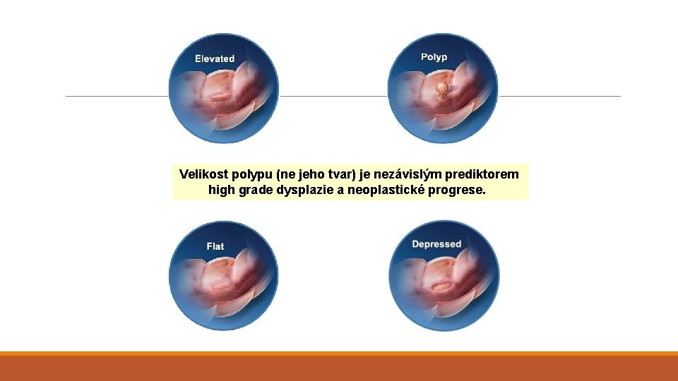 Velikost polypu (ne jeho tvar) je nezávislým prediktorem high grade dysplazie a neoplastické progrese.