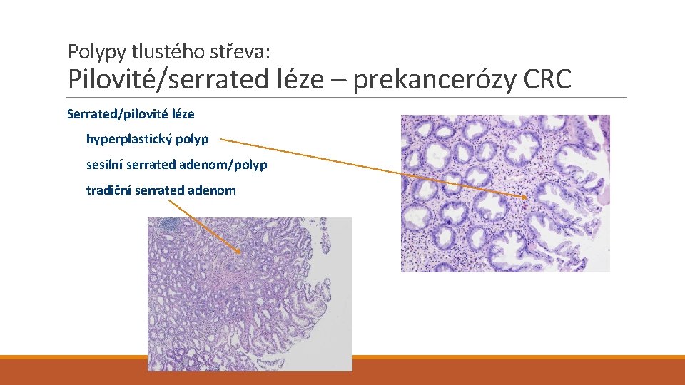 Polypy tlustého střeva: Pilovité/serrated léze – prekancerózy CRC Serrated/pilovité léze hyperplastický polyp sesilní serrated