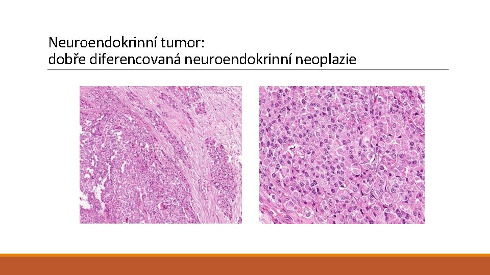 Neuroendokrinní tumor: dobře diferencovaná neuroendokrinní neoplazie 