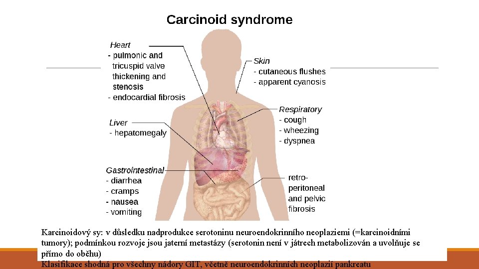 Karcinoidový sy: v důsledku nadprodukce serotoninu neuroendokrinního neoplaziemi (=karcinoidními tumory); podmínkou rozvoje jsou jaterní