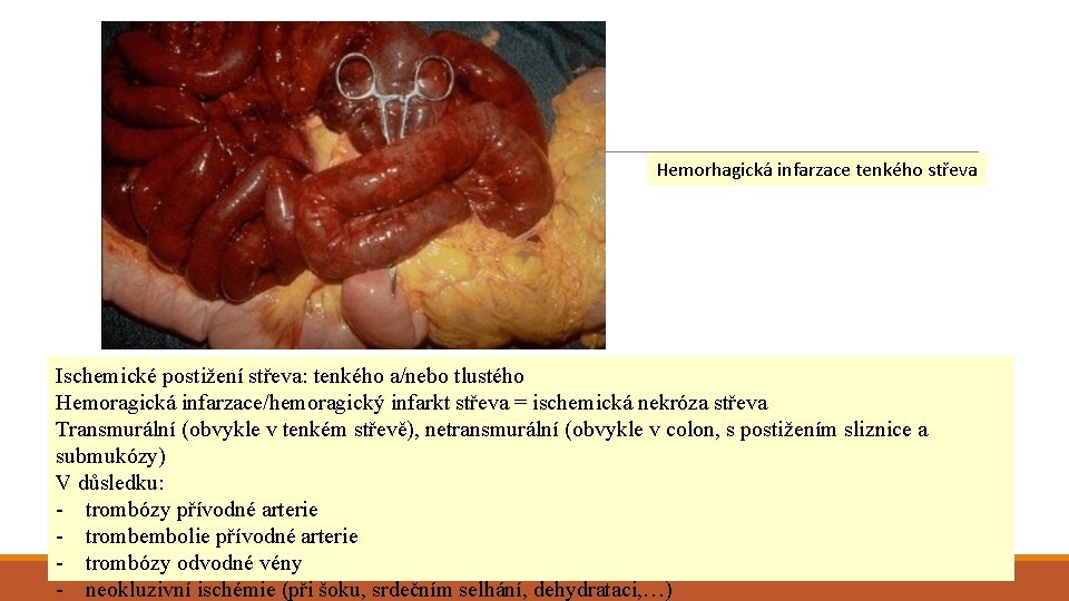 Hemorhagická infarzace tenkého střeva Ischemické postižení střeva: tenkého a/nebo tlustého Hemoragická infarzace/hemoragický infarkt střeva