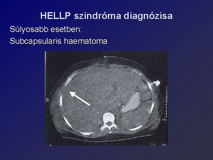 HELLP szindróma diagnózisa Súlyosabb esetben: Subcapsularis haematoma 