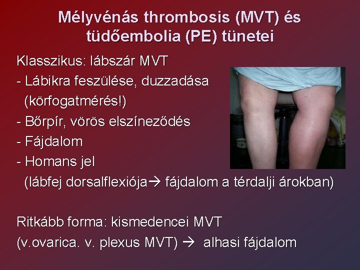 Mélyvénás thrombosis (MVT) és tüdőembolia (PE) tünetei Klasszikus: lábszár MVT - Lábikra feszülése, duzzadása