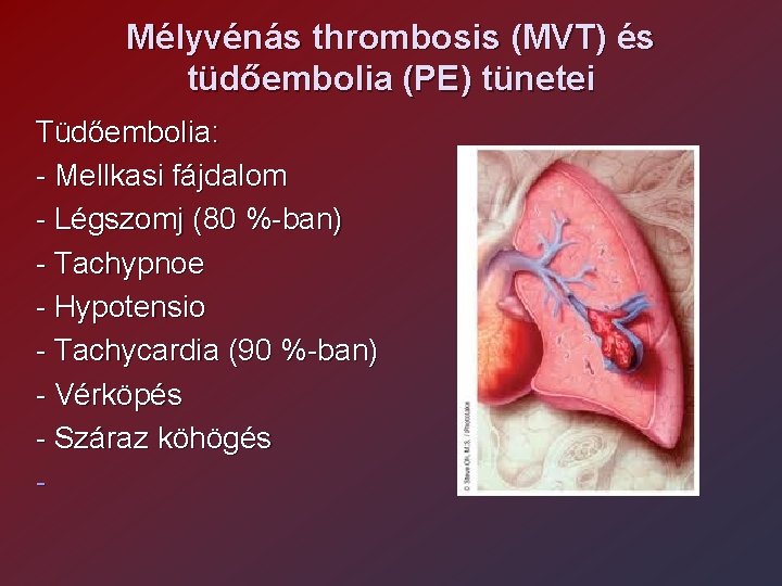 Mélyvénás thrombosis (MVT) és tüdőembolia (PE) tünetei Tüdőembolia: - Mellkasi fájdalom - Légszomj (80