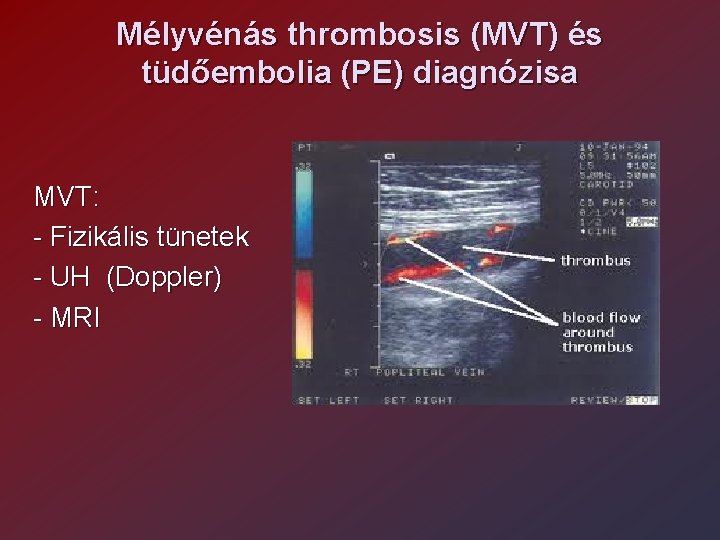 Mélyvénás thrombosis (MVT) és tüdőembolia (PE) diagnózisa MVT: - Fizikális tünetek - UH (Doppler)