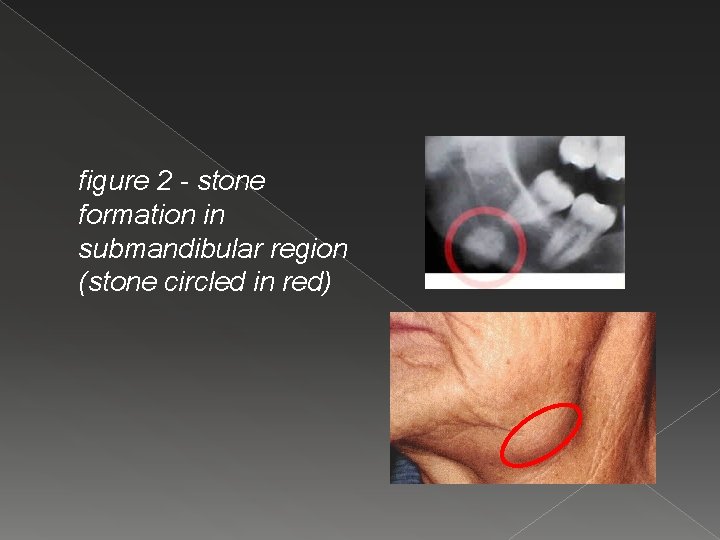 figure 2 - stone formation in submandibular region (stone circled in red) 