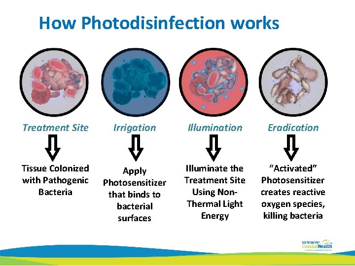 How Photodisinfection works Treatment Site Irrigation Illumination Eradication Tissue Colonized with Pathogenic Bacteria Apply