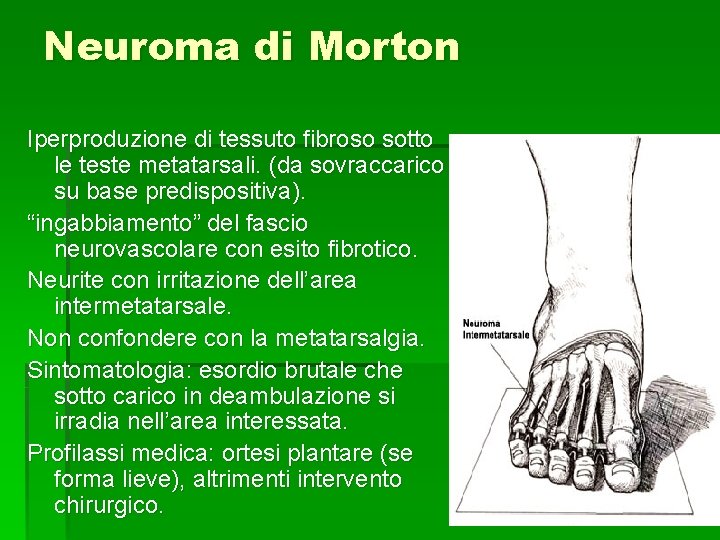 Neuroma di Morton Iperproduzione di tessuto fibroso sotto le teste metatarsali. (da sovraccarico su