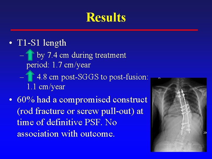 Results • T 1 -S 1 length – by 7. 4 cm during treatment