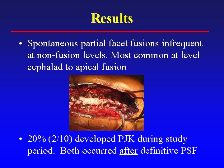 Results • Spontaneous partial facet fusions infrequent at non-fusion levels. Most common at level