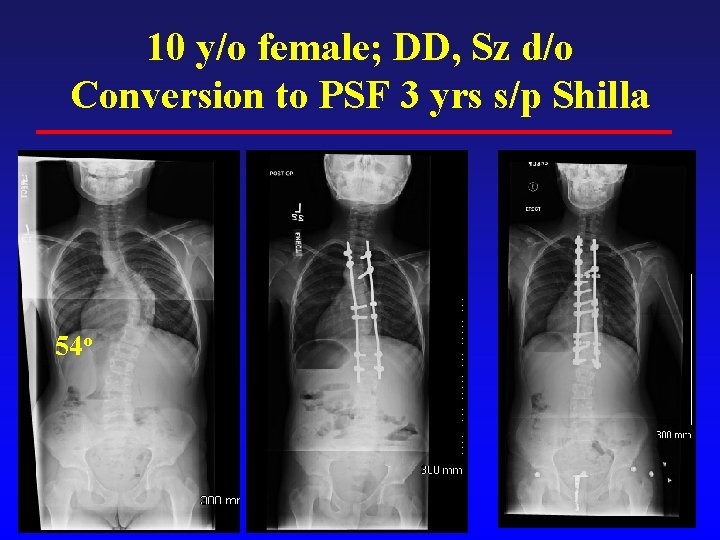 10 y/o female; DD, Sz d/o Conversion to PSF 3 yrs s/p Shilla 54