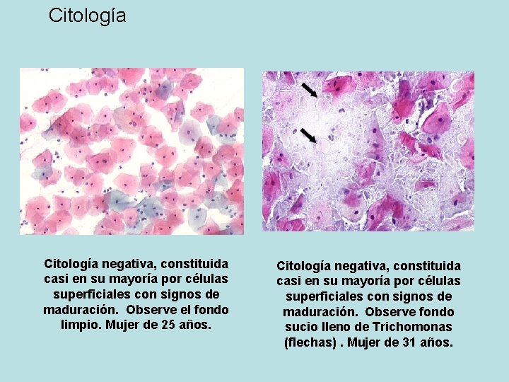 Citología negativa, constituida casi en su mayoría por células superficiales con signos de maduración.
